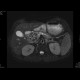 Adenocarcinoma of biliary duct: MRI - Magnetic Resonance Imaging