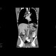 Carcinoma of oesophagus, middle third, bifurcation stent: CT - Computed tomography