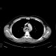 Carcinoma of oesophagus, middle third, bifurcation stent: CT - Computed tomography
