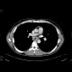 Carcinoma of oesophagus, middle third, bifurcation stent: CT - Computed tomography