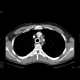 Carcinoma of oesophagus, middle third, bifurcation stent: CT - Computed tomography