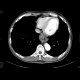 Carcinoma of oesophagus and cardia: CT - Computed tomography