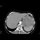 Carcinoma of pancreas, gigantic, liver metastases: CT - Computed tomography