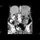 Carcinoma of pancreas, gigantic, liver metastases: CT - Computed tomography