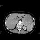 Carcinoma of pancreas, gigantic, liver metastases: CT - Computed tomography