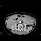 Carcinoma of pancreas, gigantic, liver metastases: CT - Computed tomography