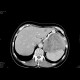 Carcinoma of pancreas, gigantic, liver metastases: CT - Computed tomography