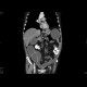 Carcinoma of colon, lienal flexure, large bowel ileus, lung metastasis: CT - Computed tomography