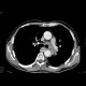 Lung carcinoma, pulmomediastinal form: CT - Computed tomography