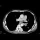 Lung carcinoma, pulmomediastinal form: CT - Computed tomography