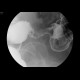 Carcinoma of sigmoid colon, barium enema: RF - Fluoroscopy