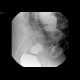 Carcinoma of sigmoid colon, barium enema: RF - Fluoroscopy