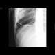 Rib tumour: X-ray - Plain radiograph