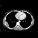 Rib tumour: CT - Computed tomography