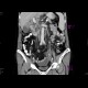 Carcinoma of gallblader: CT - Computed tomography