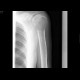 Tumorous osteolysis: X-ray - Plain radiograph