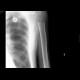 Tumorous osteolysis: X-ray - Plain radiograph