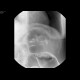Tumorous stenosis of lienal flexure, severe stenosis, barium enema: RF - Fluoroscopy