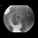 Ulcerative colitis, barium enema: RF - Fluoroscopy