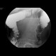 Ulcerative colitis, barium enema: RF - Fluoroscopy