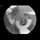 Ulcerative colitis, barium enema: RF - Fluoroscopy