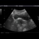 Ureterocoele: US - Ultrasound