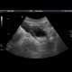 Ureterocoele: US - Ultrasound