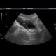 Ureterocoele: US - Ultrasound