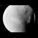 Urocystocutaneous fistula, fistulography: RF - Fluoroscopy