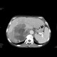 Urothelial carcinoma, gigantic: CT - Computed tomography