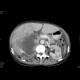 Urothelial carcinoma, gigantic: CT - Computed tomography