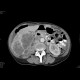 Urothelial carcinoma, gigantic: CT - Computed tomography