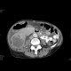 Urothelial carcinoma, gigantic: CT - Computed tomography