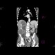 Urothelial carcinoma, gigantic: CT - Computed tomography