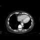 Vena cava sinistra, continuation of hemiazygous vein: CT - Computed tomography