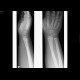 Greenstick fracture of distal radius: X-ray - Plain radiograph