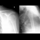 Dislocation of shoulder, anterior luxation: X-ray - Plain radiograph