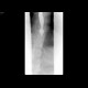 Carcinoma of oesophagus, tumorous stenosis: RF - Fluoroscopy