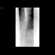 Carcinoma of oesophagus, tumorous stenosis: RF - Fluoroscopy