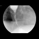 Carcinoma of oesophagus, tumorous stenosis: RF - Fluoroscopy