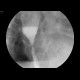 Carcinoma of oesophagus, tumorous stenosis: RF - Fluoroscopy