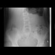 Volvulus, small bowel ileus: X-ray - Plain radiograph