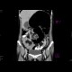 Volvulus, small bowel ileus: CT - Computed tomography