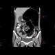 Volvulus, small bowel ileus: CT - Computed tomography