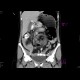 Volvulus, small bowel ileus: CT - Computed tomography