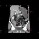 Volvulus, torsion of mesentery, small bowel ileus: CT - Computed tomography