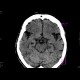 Ischemia, temporal lobe, first CT: CT - Computed tomography