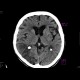 Ischemia, temporal lobe, second CT: CT - Computed tomography