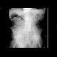 Constipation: X-ray - Plain radiograph