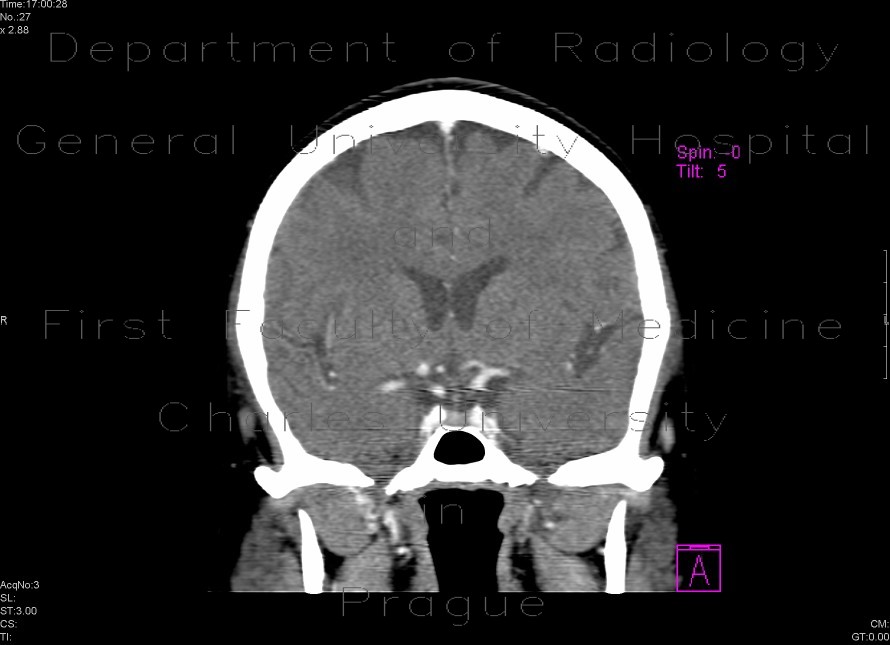 Radiology image - A tiny intracranial aneurysm on the branching ACA and ACM: Brain, Vessels: CT - Computed tomography